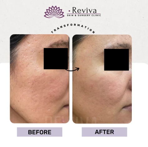 Before and after result 9